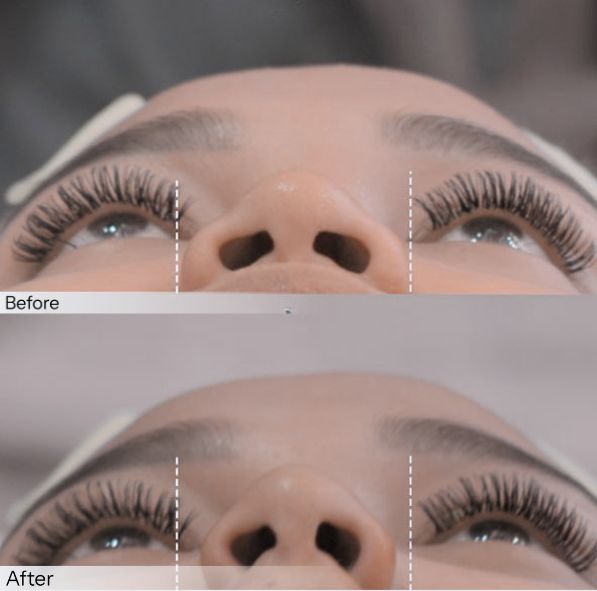 benang hidung insta beauty center