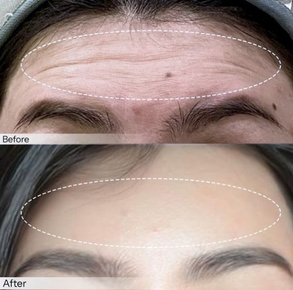 botox insta beauty center
