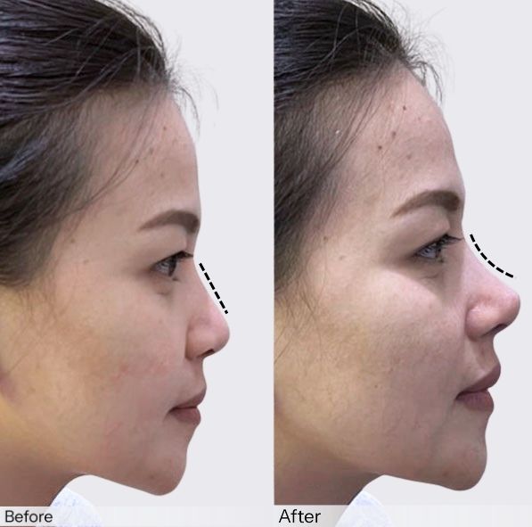 tanam benang hidung insta beauty center