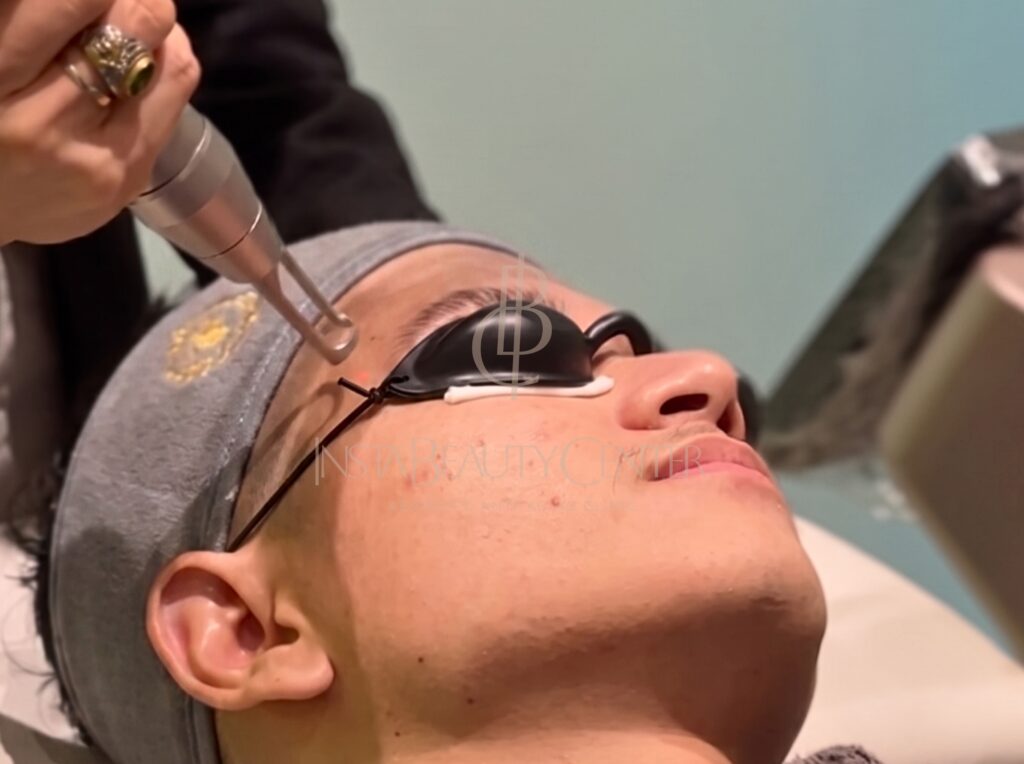 Perawatan Wajah Pria di Insta Beauty Center_ Treatment Modern untuk Cowok yang Ingin Tampil Fresh & Maskulin